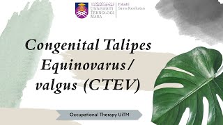 LESSON 8 CONGENITAL TALIPES EQUINOVARUSVALGUS CTEV [upl. by Ama]