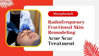 Morpheus8  Radiofrequency Fractional Skin Remodeling  Acne Scar Treatment  Jason Emer MD [upl. by Ribaj]