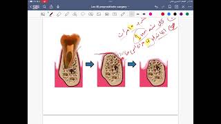 Preprosthetic Surgery lec8 stage5 [upl. by Eiraminot]