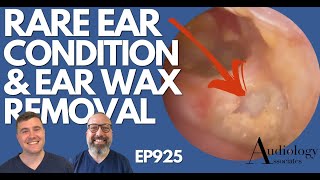 RARE EAR CONDITION amp EAR WAX REMOVAL  EP925 [upl. by Atnahsa41]