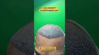 Hair Loss Treatment hair hairloss hairlosstreatment ytshorts alopecia hairtransplant hairfall [upl. by Vez]