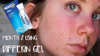 MONTH 2 USING DIFFERIN GEL  Skin Update [upl. by Anaeed]