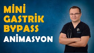 Mini Gastrik Bypass MGB animasyon  Op Dr Fakı AKIN [upl. by Stelmach]