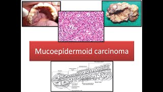 Mucoepidermoid carcinoma [upl. by Kurman885]