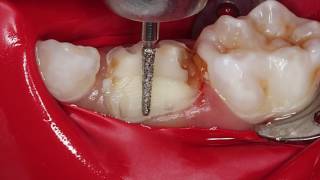 MTA Pulpotomy and zirconia crown by Jorge Casián México [upl. by Leur]