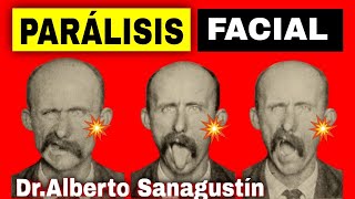 PARÁLISIS FACIAL 💥 Síntomas Causas y Tratamiento [upl. by Kersten]