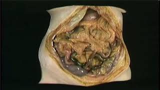 ANATOMIE FMPM CAVITÉ ABDOMINALE DISSECTION [upl. by Sirrot]