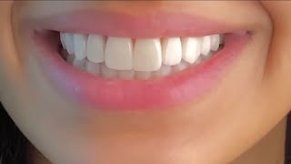 ღ your teeth are literally perfect  veneers procedure 💉 [upl. by Halsted]