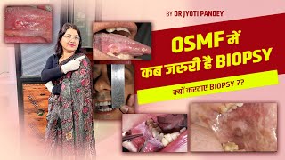 OSMF में कब जरुरी है BIOPSY क्यों करवाए BIOPSY [upl. by Bohs460]