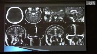 MRI CT Findings In Hydrocephalus with Increased Intracranial Pressure by Hamza Alsayouf [upl. by Harak]