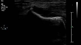 Ultrasound examination TENNIS ELBOW Lateral epicondylitis Chronic  osteophyte [upl. by Pike864]