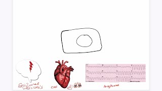 Refeeding Syndrome Explained USMLE [upl. by Hcab]