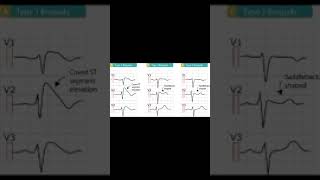 Brugada Syndrome Symptoms and Causes  Diagnosis  Treatment  Prevention disease healthcare [upl. by Feirahs]