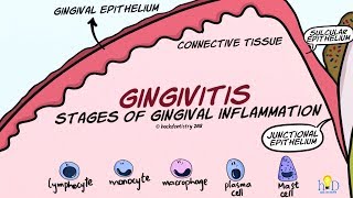 Gingivitis Stages of Gingival Inflammation [upl. by Topliffe]