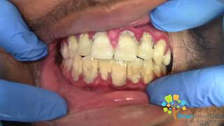 Dental Cleaning to remove heavy tartar🦷 【Young Male first cleaning】 [upl. by Enelrak171]