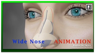 Rhinoplasty Animation  How can a Wide nose be narrowed [upl. by Bollinger]