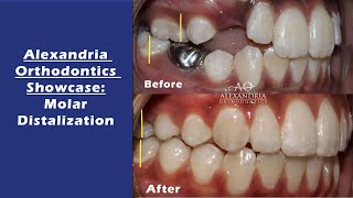 Alexandria Orthodontics Showcase Molar Distalization [upl. by Htebaras708]