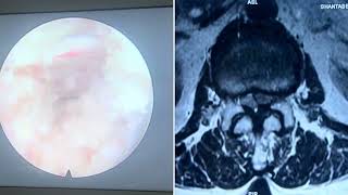 Interlaminar Endoscopic Decompression Multilevel Lumbar canal stenosis in old age [upl. by Sofie]