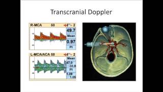 Natus TCD Webinar Performance of the Normal TCD Examination [upl. by Gathard]