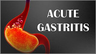 Acute Gastritis  Signs amp Symptoms Causes Pathogenesis Complications Diagnosis amp Treatment [upl. by Haeel]