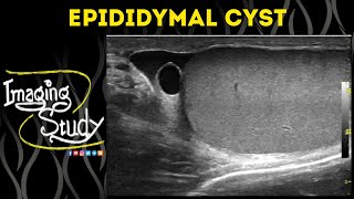 Epididymal Cyst  Ultrasound  Case 51 [upl. by Lukash95]