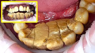 47 yo Males Teeth Gigantic Tartar Removal  Scaling [upl. by Ysor]