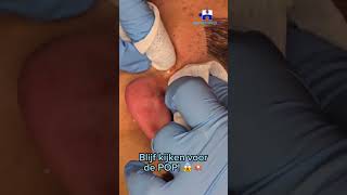 POP pimple pimplepopping pimplepopper puist pop wow skin skincare [upl. by Dianuj180]