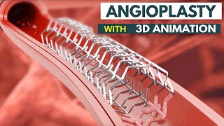 Angioplasty Procedure Explained How It Saves Lives  What Is Angioplasty StepbyStep Explanation [upl. by Rovert573]