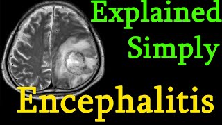 Encephalitis  brain inflammation  Symptoms causes prognosis Treatment explained simply [upl. by Enahc]