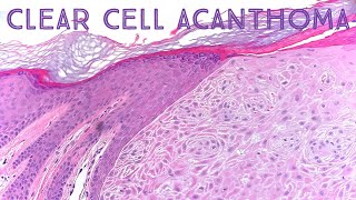 Clear Cell Acanthoma Dermpath in 5 Minutes pathology dermatology dermatopathology [upl. by Liagibba]