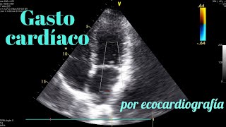 Gasto cardíaco fácil por eco  ¿Qué es el VTI [upl. by Nare347]