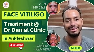 Dr Danials Face Vitiligo Treatment  Amazing Before amp After Results of Mohan  vitiligotreatment [upl. by Noy]