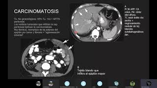 Neoplasias Peritoneales [upl. by Akinert]