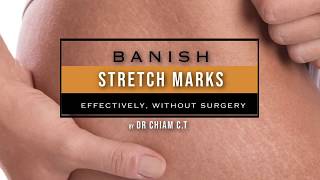 Stretch Marks How They Appear amp Options To Reduce Their Appearance [upl. by Hadnama]