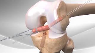 Ligamentoplastie du genou pour rupture du ligament croisé antérieur par DT4 [upl. by Blackman]