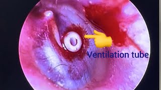 Ventilation tube insertion Part2 [upl. by Ytissac]