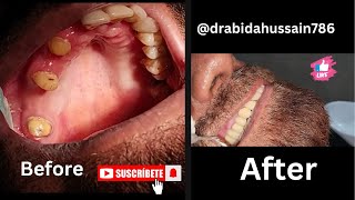 smile Makeover with porcelain bridge dentistry dentista drabidahussain786 drabidahussain786 [upl. by Erdda]