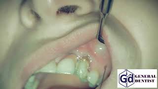 Infiltration anesthesia for treatment tooth 22 [upl. by Erbe]