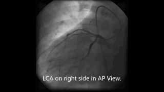 Situs Inversus Dextrocardia [upl. by Ahsuat]