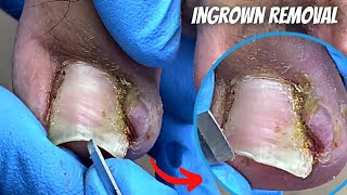 Remove this Long Infected ingrown toenail pain  Podiatrist Pedicure treatment amp How to cut cure [upl. by Nitas]