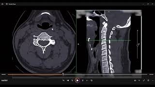 nect ct anatomy aryepiglottic foldscobra fangs analogy [upl. by Shields]