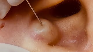 NEW Large Cyst Removal BEST POPS Compilation  w relaxing music amp an OOZ GALORE [upl. by Bernelle]