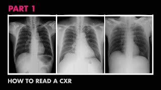 Anatomy of a Chest XRay  How to Read a Chest XRay Part 1 [upl. by Nollaf209]