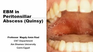 EBM in Peritonsillar Abscess Quinsy [upl. by Kirit]