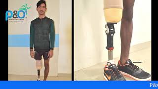 Knee Disarticulation Prosthesis with Carbon Fibre Socket leg pointernationalprivatelimi3612 [upl. by Carolee]