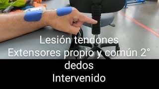 Lesión tendones extensor propio y común 2° dedo tratamiento [upl. by Yoko724]