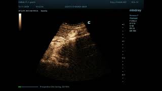 Hemangioma 33 CEUS [upl. by Feinberg630]