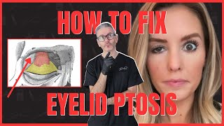 3 Ways to Fix Eyelid Ptosis After Botox [upl. by Oringa]