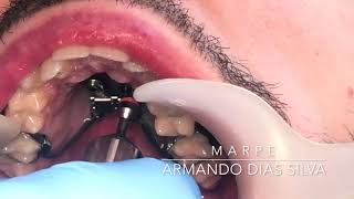 MARPE Skeletal Maxillary Rapid Expansion [upl. by Ikkin]