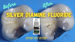 Silver Diamine Fluoride  Step By Step Demonstration [upl. by Paloma]